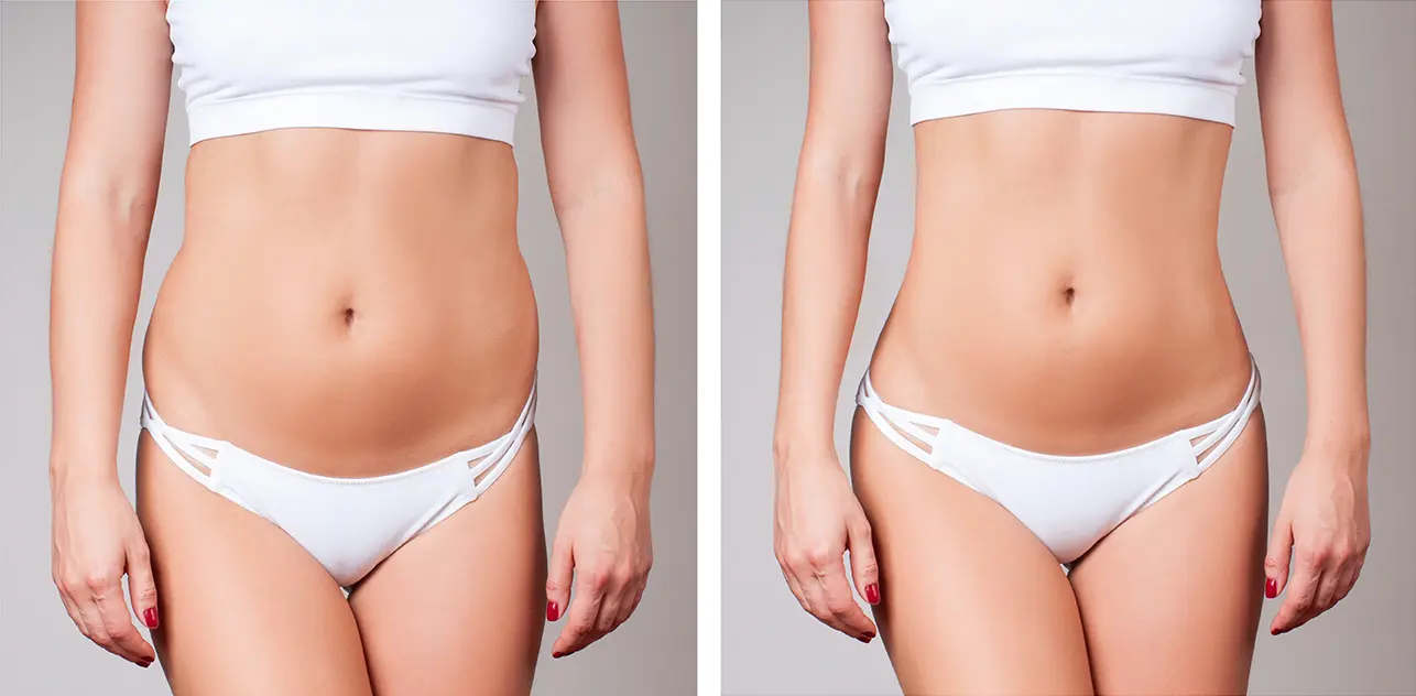 Significant body improvement after UltraShape