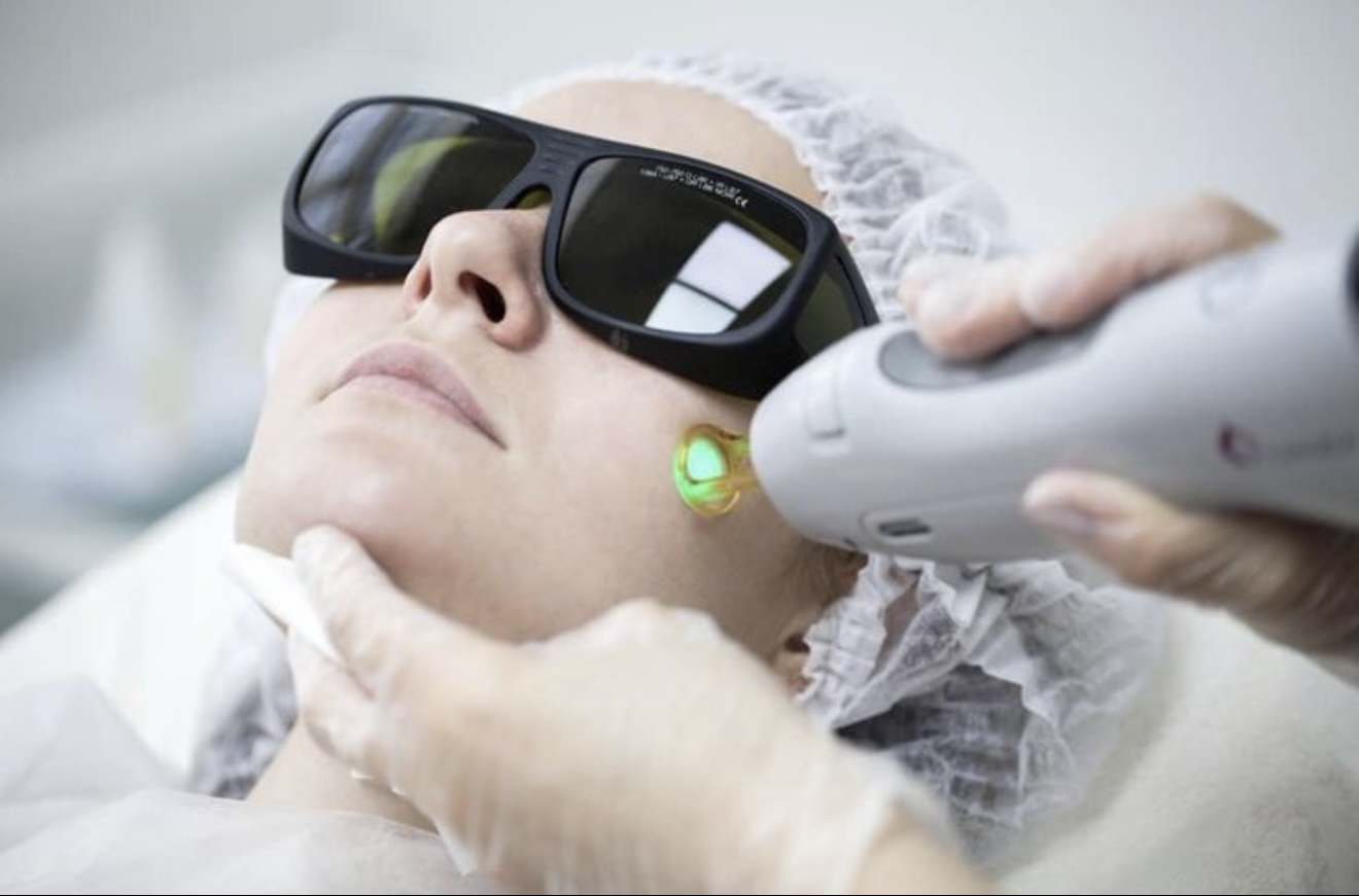 Laser-hair-removal 2