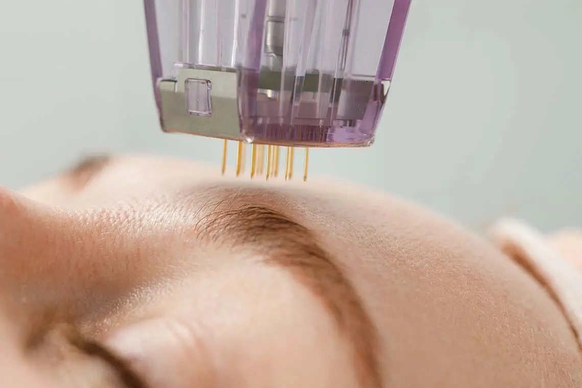 The beginning of the Microneedling process