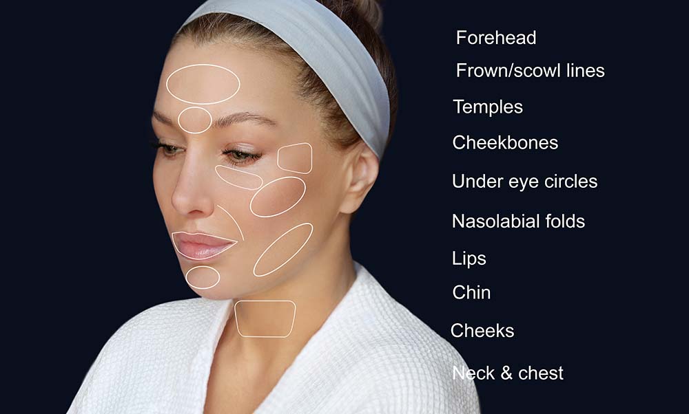 Photo of areas where fillers are used