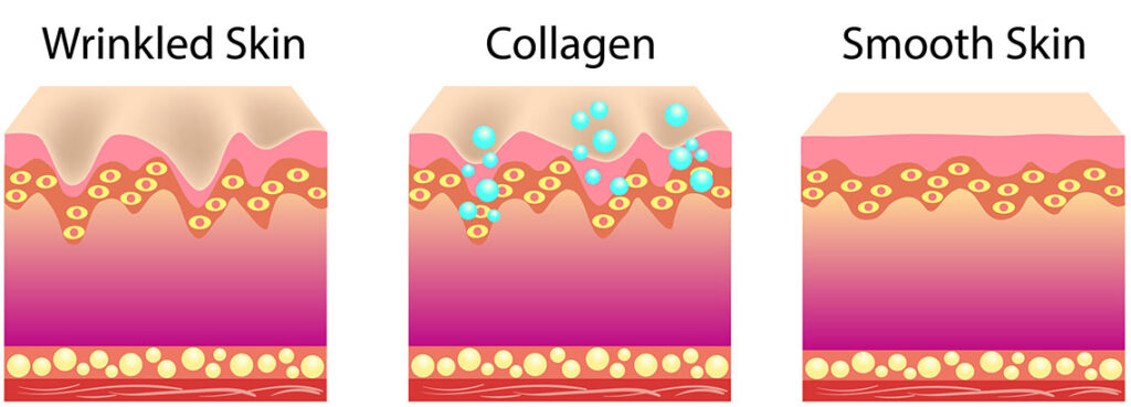 Micro-injuries and the production of new collagen make the skin smooth