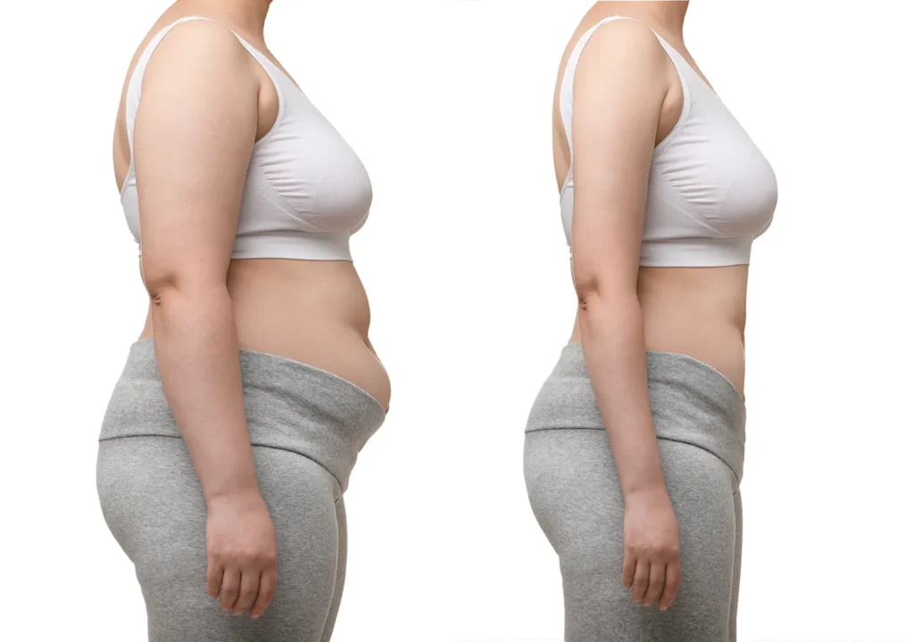 Before and after the use of semaglutide for weight loss