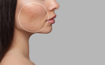 Clogged Pore Cleansing