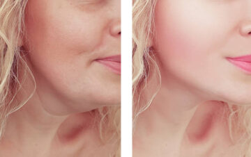 Double Chin Removal