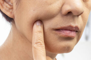 Loose Skin Treatment