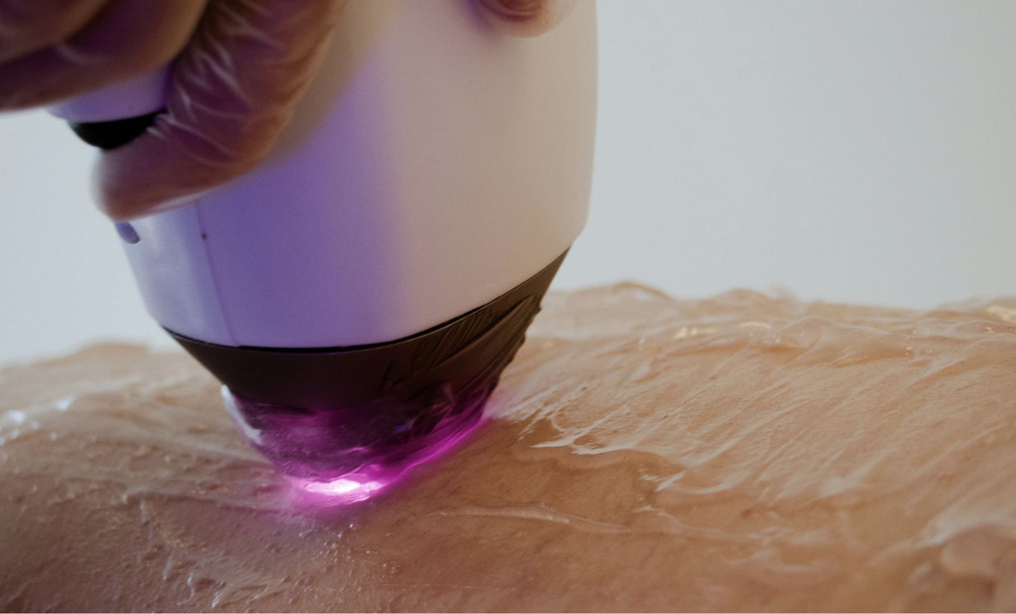 Laser hair removal