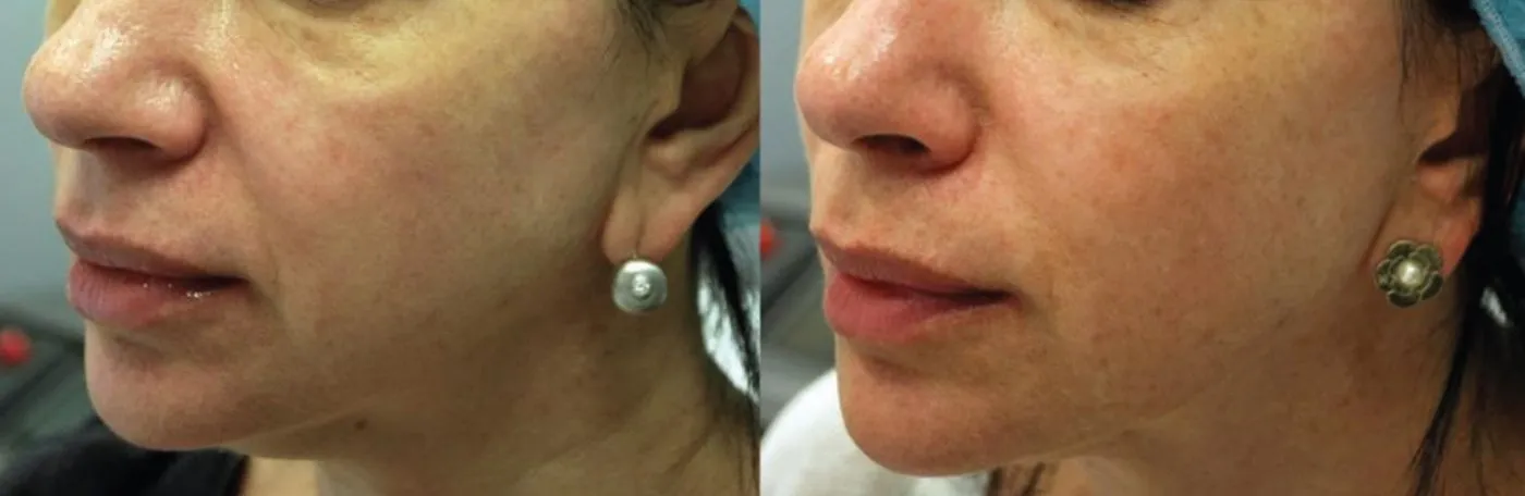 Morpheus8 Microneedling
