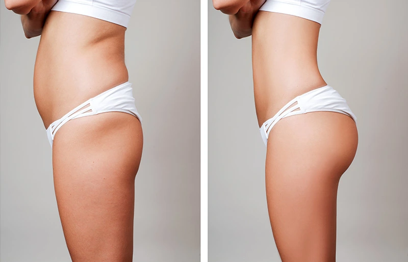 Sculptra for Buttocks