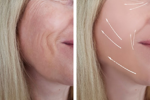 Sculptra for Hip Dips