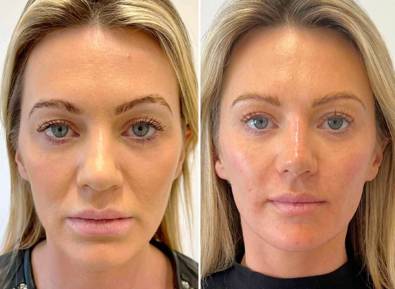 Facial Fillers treatment miami fl
