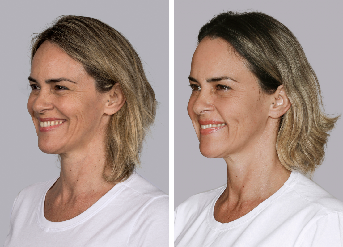 Sculptra treatment miami fl