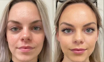 dermal Fillers in miami fl