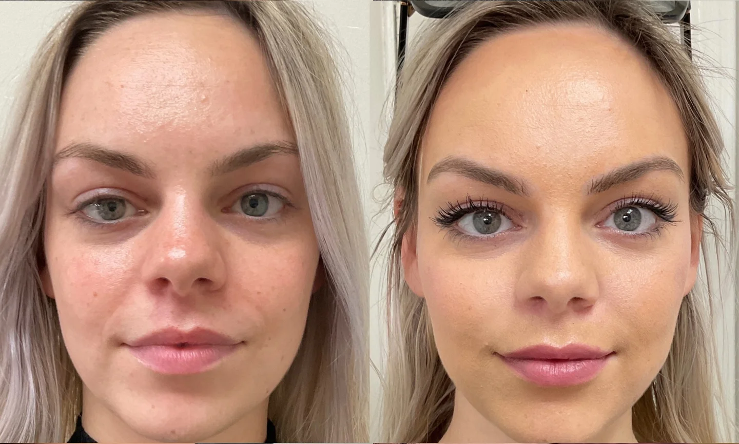dermal Fillers in miami fl