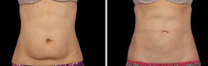 Fat-Burning Injections in mimi fl