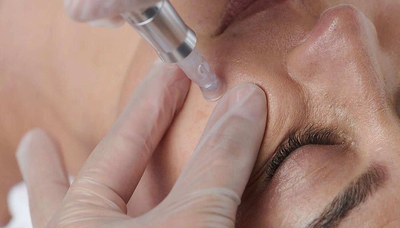 Microneedling treatment miami fl