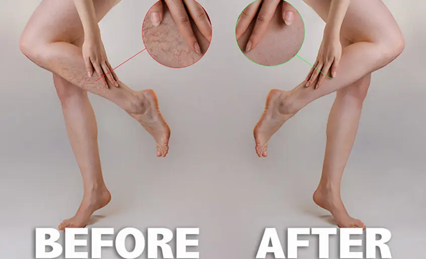 Sclerotherapy spider veins terapy miami fl