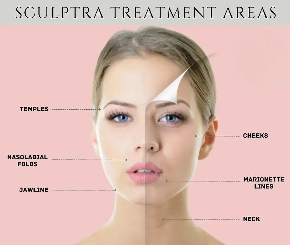 Sculptra in Brickell Miami