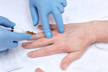 Sclerotherapy for Hands in Miami