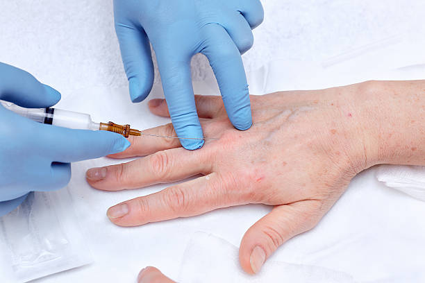 Sclerotherapy for Hands in Miami