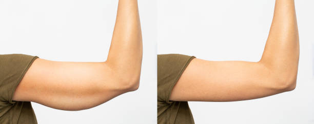 Arms Tightening Treatment-Miami-promo-before-after