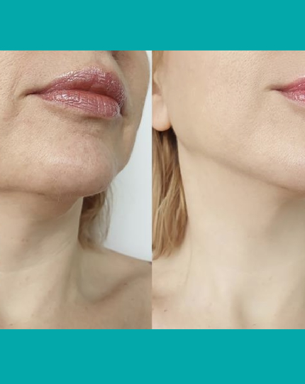 Non-Surgical Facelift Treatment - $59​ - tile