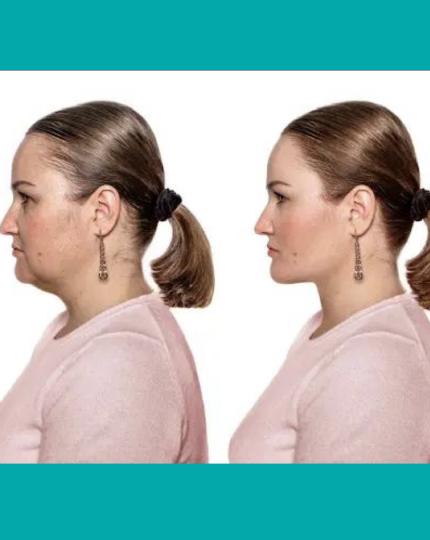 RF Double Chin & Jawline Sculpting Treatment - $59​ - tile