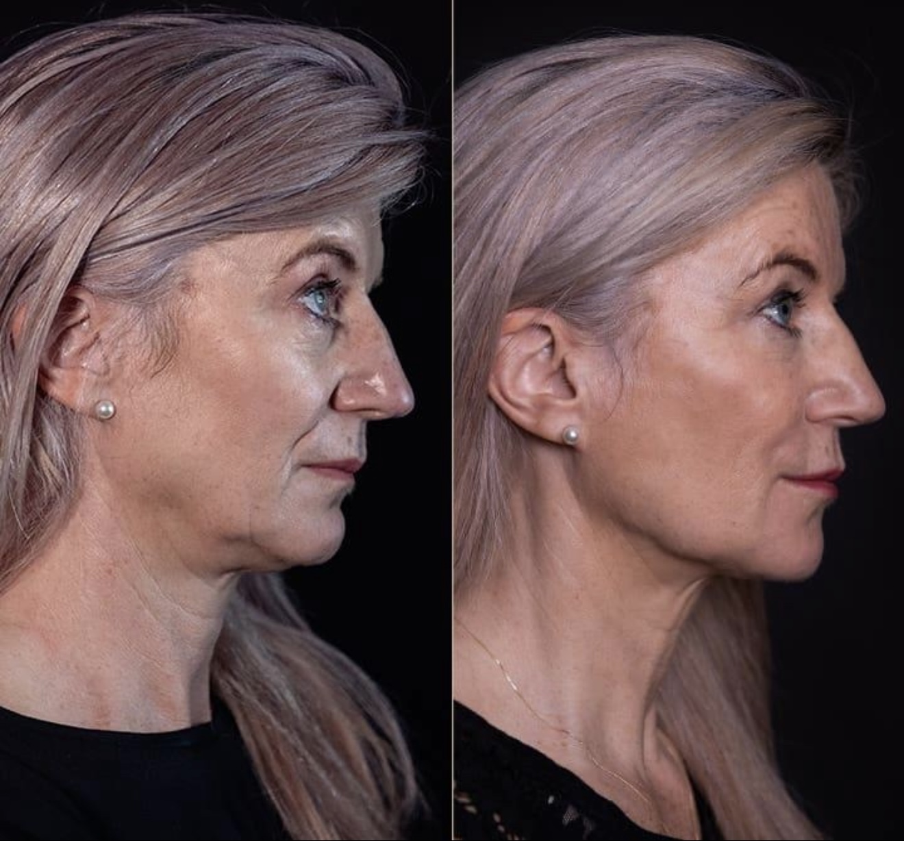 Say Goodbye to Turkey Neck Treatment - $59​ - 3