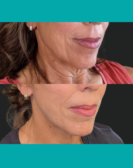 Say Goodbye to Turkey Neck Treatment - $59​ - tile