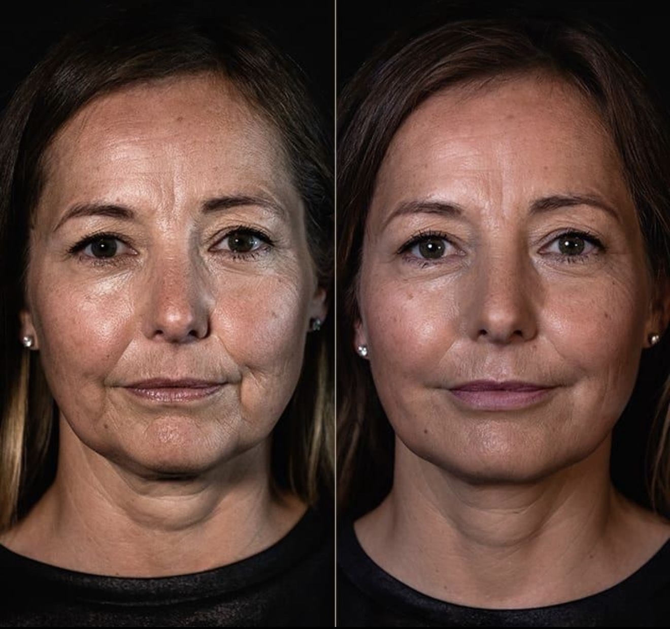Smooth Marionette Lines Treatment - $59 - 3
