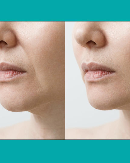 Smooth Marionette Lines Treatment - $59 - tile