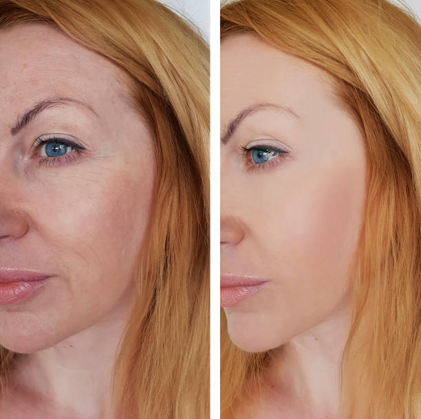 Lumecca before after